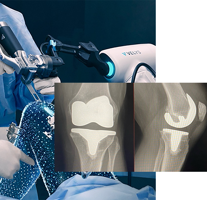 knee replacement with Dr. Grayson P. Connors