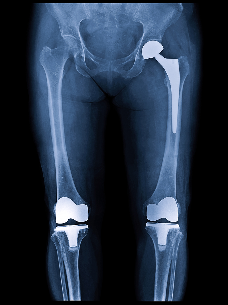 knee replacement surgery with dr. grayson p. connors